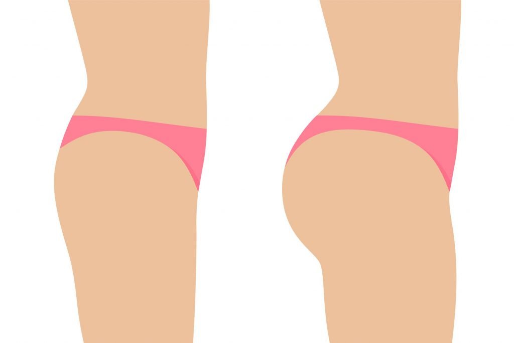 عملية BBL (Brazilian Butt Lift): دليل شامل وآمن